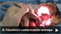 Dr. Fukushima’s suction aspirator technique